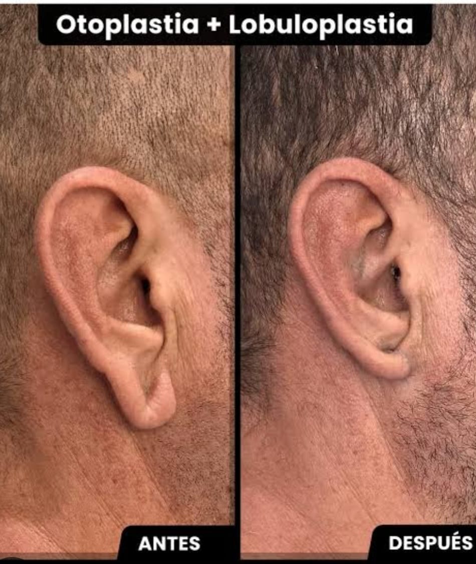 Resultado Otoplastia 4